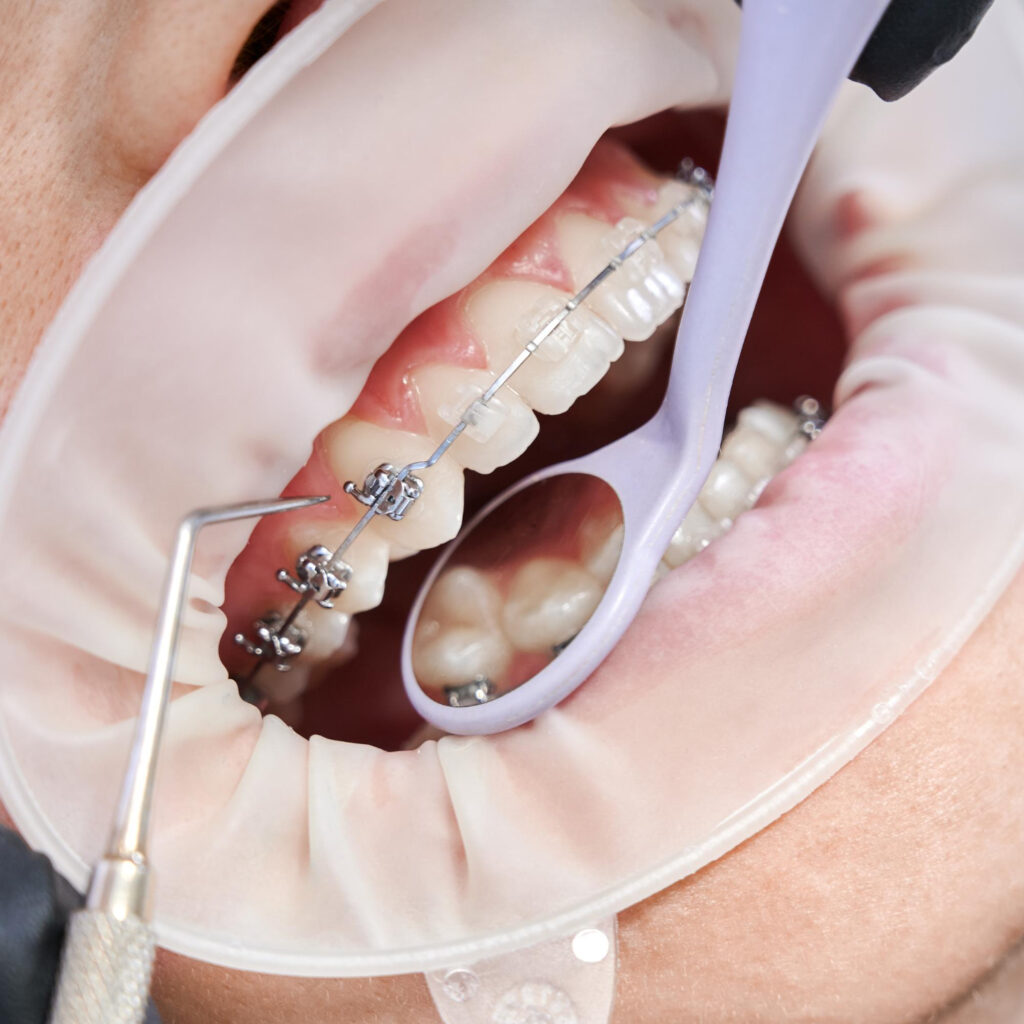 dentista colocando frenos metalicos dientes paciente