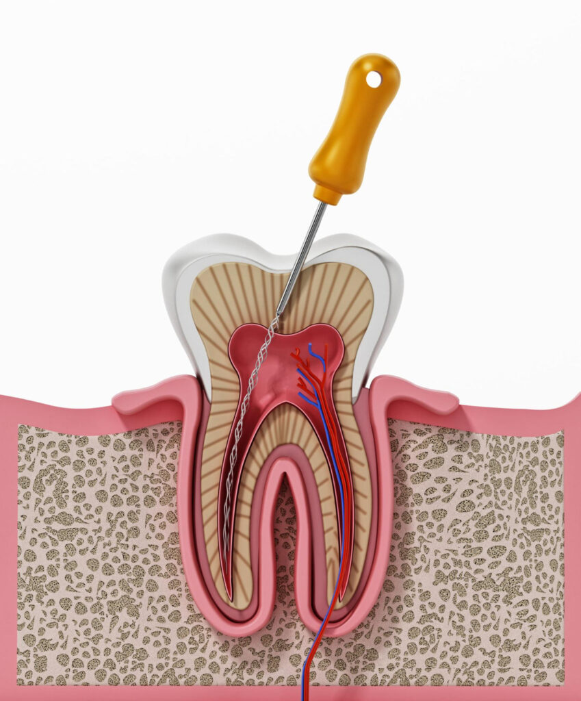 ilustracion 3d proceso tratamiento conducto radicular